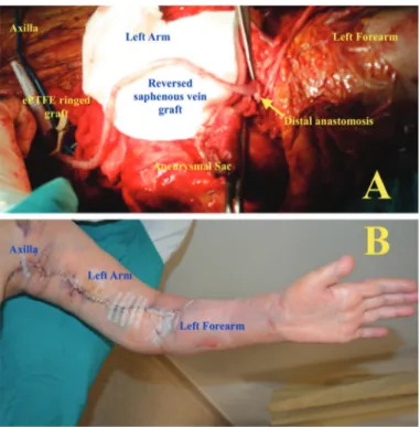 Figure 2. The revascularization procedure: (A) and postoperative  day#3 view of the left arm (B)