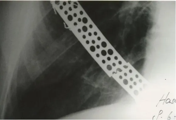 Figure 1. Preoperative USG  showed  rib abcess 