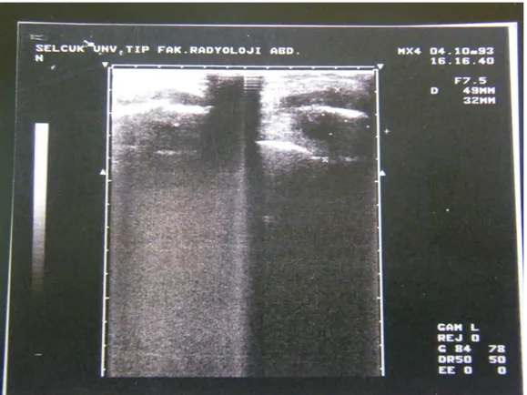 Figure 2. Chest-X ray  shows a fracture in the steel graft 