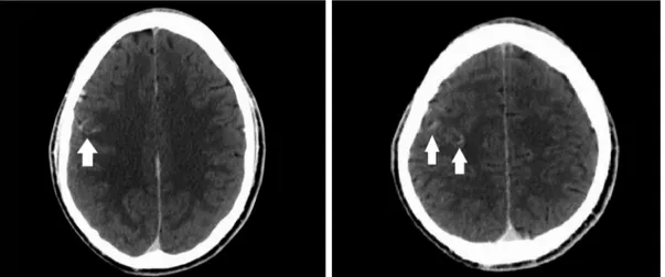 Şekil 1.  Aksiyal bilgisayarlı beyin tomografi: Sağ parietal bölgede subaraknoid kanama görüntüsünü taklit eden kontrast madde tutulumu