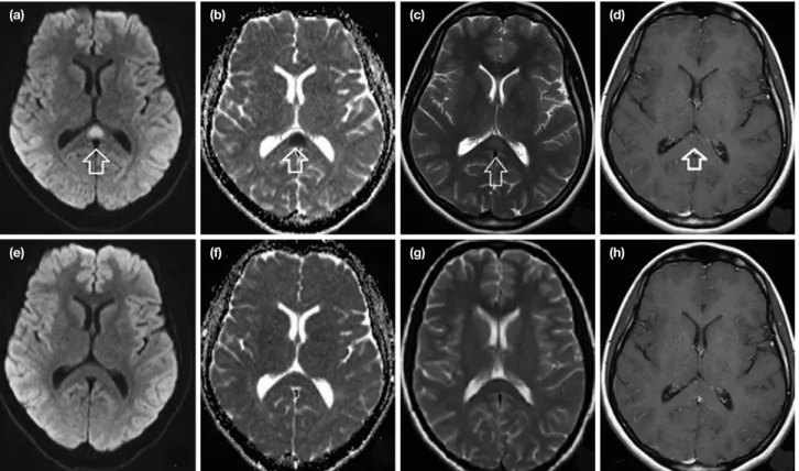 Figure 1. a–h. Magnetic resonance imaging of case 1: Initially (a–d); 10 days later (e–h)