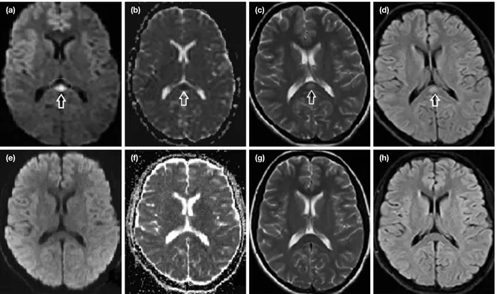 Figure 2. a–h. Magnetic resonance imaging of case 2: Initially (a–d); 10 days later (e–h)