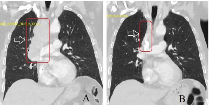 Fig. 2. Thoracic computed tomography: A) Before treatment B) After treatment   Paraneoplastic  LEMS  was  detected  especially  in 