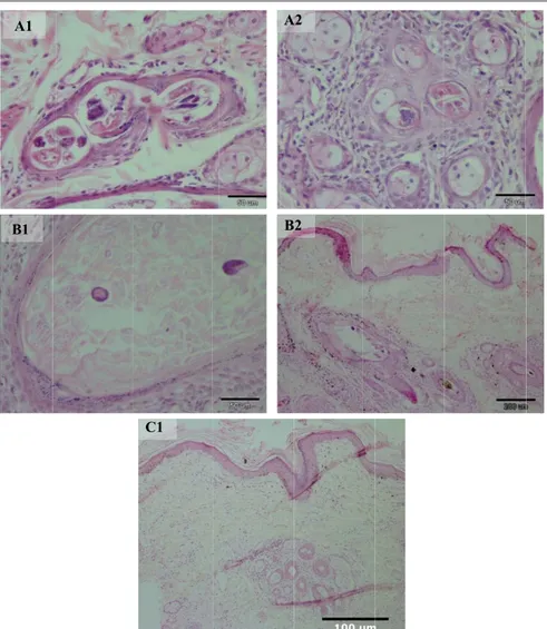 Şekil 2. Tedavi öncesi (A1, A2), tedavinin 4 (B1, B2)  ve 8. (C1) haftasında kıl folikülleri ve yağ bezlerinin  histopatolojik görünümü
