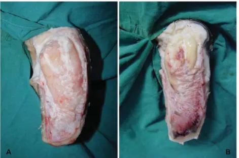 Fig 3.A-B. Appearence of the digital cushion’s  segments after the sole dissection 