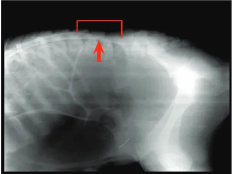 Fig 1. Myelography. The constriction at the 3 rd  and 4 th lumbar spinal cord