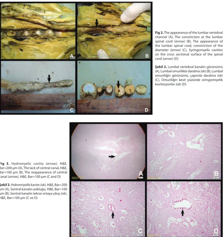 Fig 2. The appearance of the lumbar vertebral  channel (A), The constriction at the lumbar  spinal cord (arrow) (B), The appearance of  the lumbar spinal cord, constriction of the  diameter  (arrow) (C), Syringomyelic cavities  on the cross sectional surfa