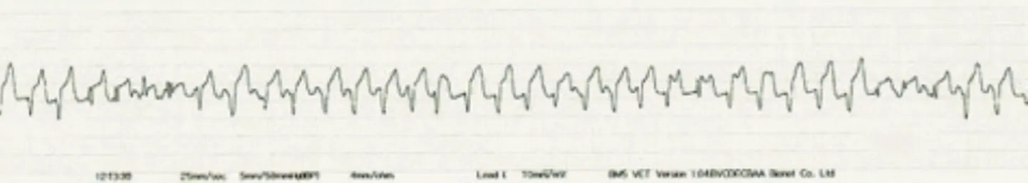 Figure 2. ECG tracing shows continuously polymorphic complexes at 200 beat/min heart rate (Lead II, 25 mm/sec and 10 mm/mV).