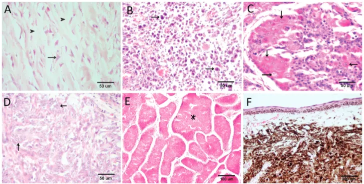 Figure 2. Histopathological samples of various tumor tissues. (A) Osteosarcoma. Atypical osteoblast (arrow) and osteoid tissues (arrow head),  (B) Malign melanoma (Mixed type)