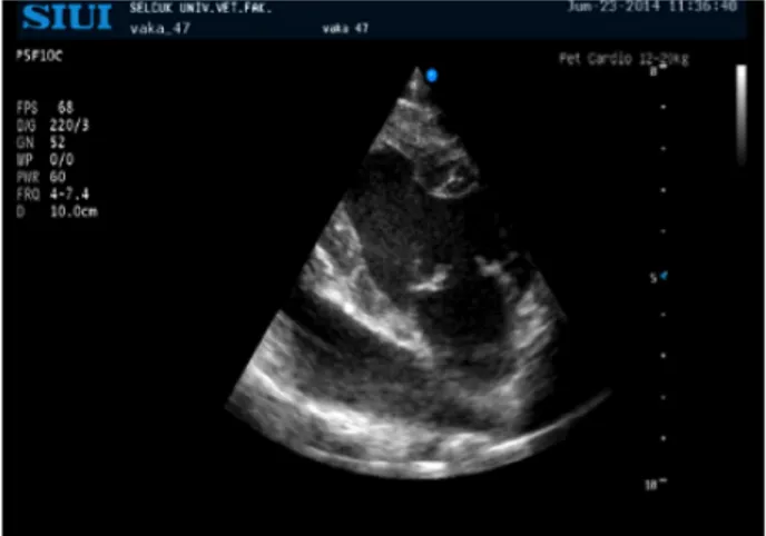 Figure 1. Left apical four-chamber view, both mitral valves are fibrotic and  nodular.