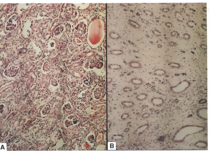 Şekil  4.  Böbrek  hipoplazisi.  A.Tubulus  Ile glomeruluslar farklı büyüklükte, bazı tubuluslarda dilatasyon Ile  proıein silindirleri
