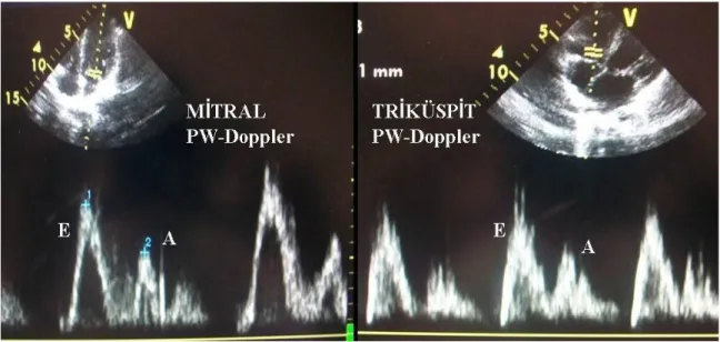 Şekil 4: Mitral ve triküspit kapağa ait pulse Doppler görüntüleri 