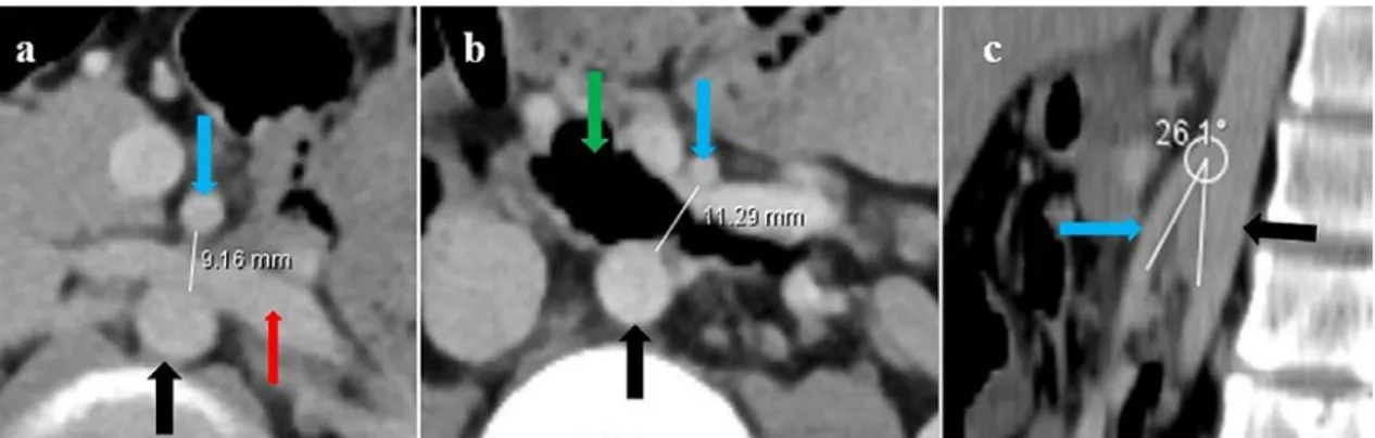 Figure 1 a, b, c. Contrast abdominal CT investigation: Measurement distances on axial slices at level of LRV (a)  and duodenum (b)