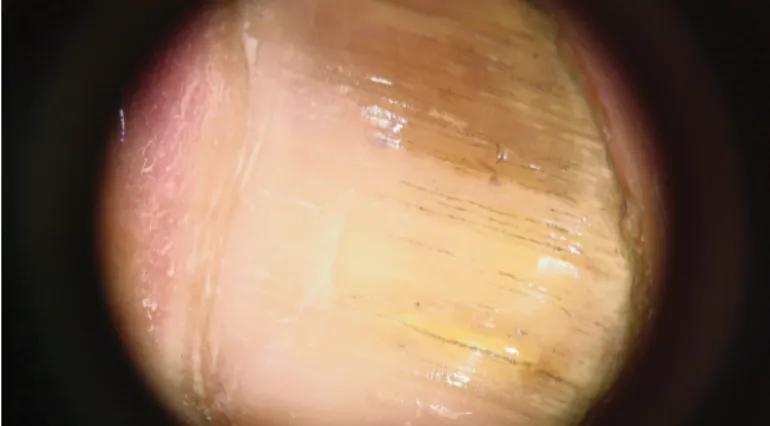 Figure 1. Longitudinal striae which is whitish to brown in  the onycholytic nail plate