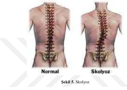 Şekil 5. Skolyoz 