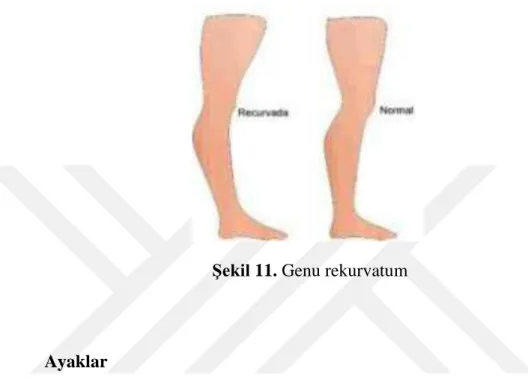 Şekil 11. Genu rekurvatum 