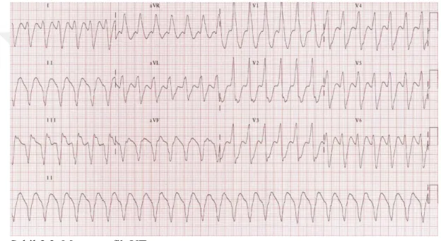 Tablo  3.11.  incelendiğinde  çalışmaya  katılan  paramediklere  Şekil  3.2.’deki  EKG görseli verilmiş ve nVT’nin tedavisi sorulmuştur