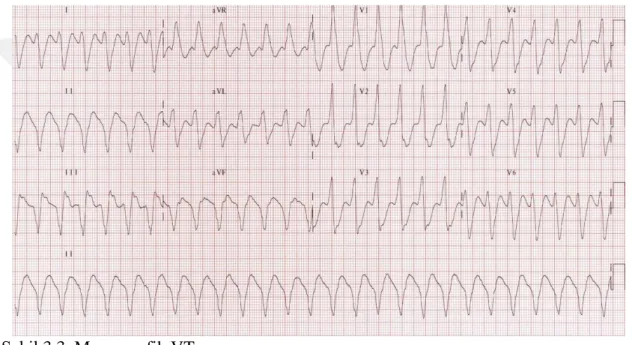 Tablo  3.12.  incelendiğinde,  araştırmaya  katılan  paramediklere  Şekil  3.3.’te  yer  alan  EKG  grafiği  ile  bilinç,  tansiyon  ve  nabız  parametreleri  verilmiştir