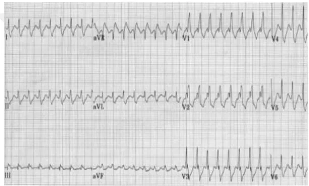 Tablo  3.16  İncelendiğinde  çalışmaya  katılan  paramediklere  Şekil  3.7.’deki  Aberran İletimli SVT’nin EKG görseli verilmiş ve bu ritmin ne olduğu sorulmuştur