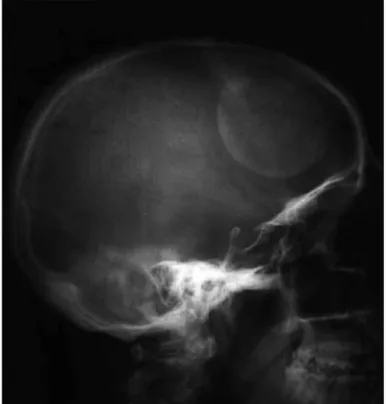 Figure 1. Calcified mass in the frontal region on direct cranial x-ray