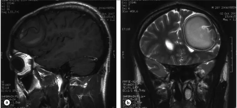 Figure 3. a) T1-weighted sagittal MRI shows intracystic membranes and b) T2-weighted coronal MRI shows membrane detachment