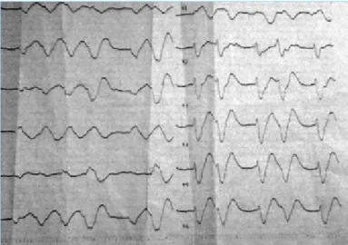 Figure 1. Twelve-lead ECG trace before cardiac arrest