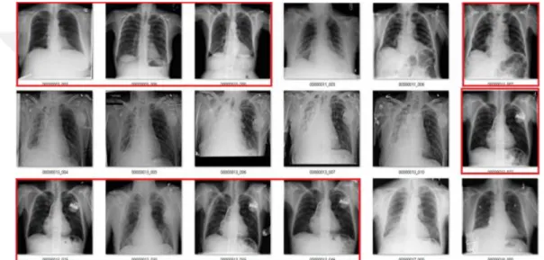 Şekil 3.11. NIH göğüs röntgeni veri kümesi örnekleri (Kaggle) 