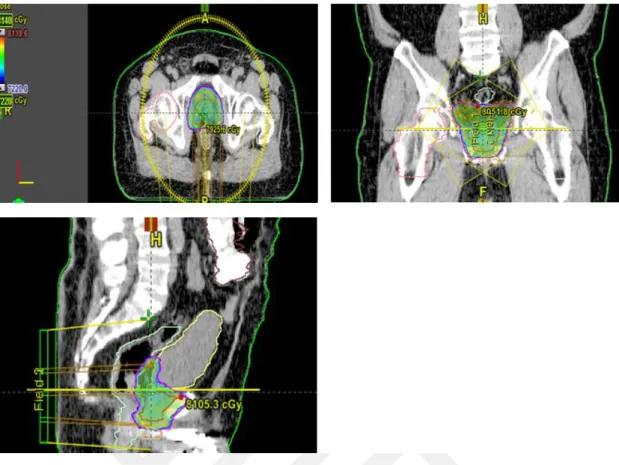 Şekil 3.8. VMAT tekniği ile yapılan bir prostat hasta planının üç boyutta doz dağılımı 