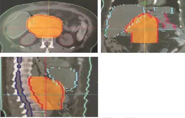Şekil 3.19. Tomoterapi tekniği ile yapılan bir GBM hasta planının üç boyutta doz dağılımı 