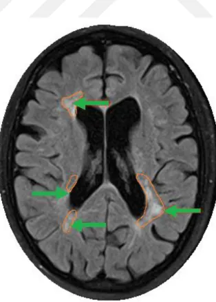 Şekil 1.13. MS hastasına ait beyin MR görüntüsü(Türk Nöroloji Derneği 2018) 