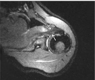 Figure 2. Axial MR imagine shows improving on subscabularis tendon.