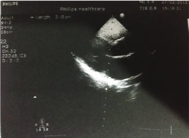 Şekil  1.    Olgunun  ekokardiyografisinde  aort  çapı  öl- öl-çümü
