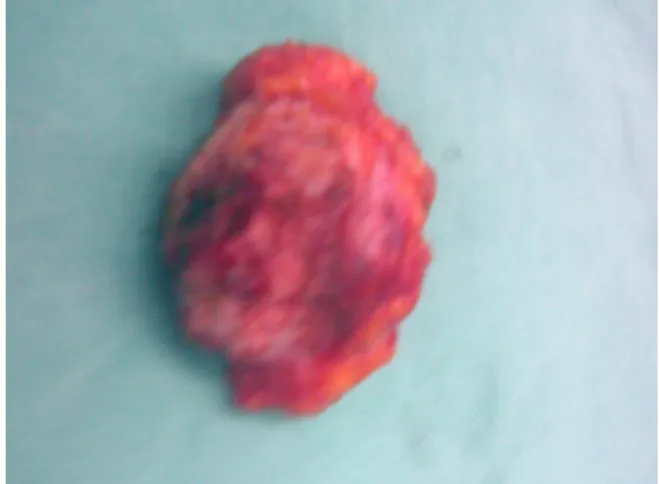 Şekil 2.  Çevre sağlam dokuyu da kapsayacak şekil- şekil-de eksize edilen endometrioma, makroskopik görünüm