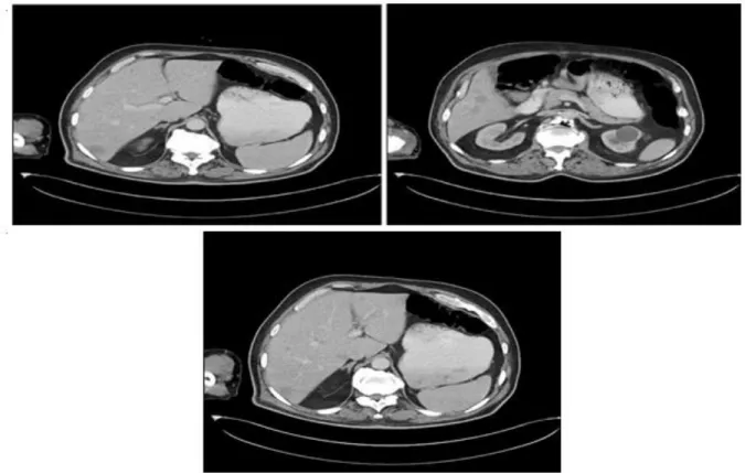 Figure  1:  Multipl  metastatic  lesions  are  seen  in  left  and  right  lobes  of  the  liver