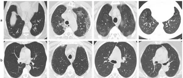 Figure 1. Sample images from SARS-CoV-2 CT scan dataset, a) infected by SARS-CoV-2 CT scan dataset,  b) non-infected by SARS-CoV-2 CT scan dataset 