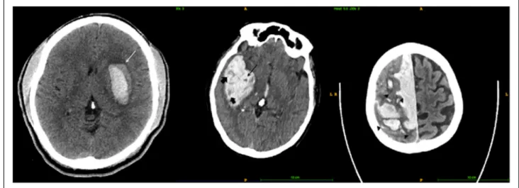 Figure 1.  Shows the blend sign (left, white arrow), black hole sign (middle, black arrow), hypodensities (thick arrows), and island sign (right, black arrow  heads showing multiple small islands).