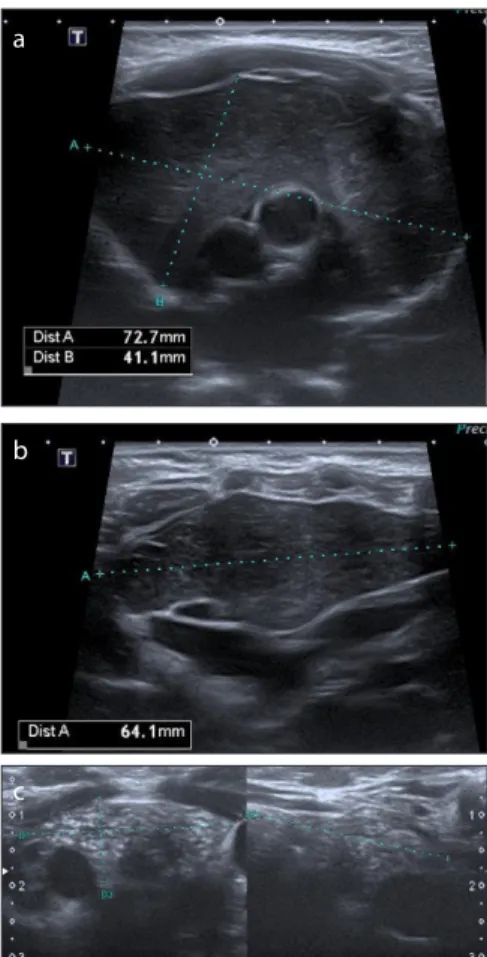 Figure 2. a, b. Shear wave elasticity (SWe) measurements and propagation map on shear wave  elastography (SWE) are seen