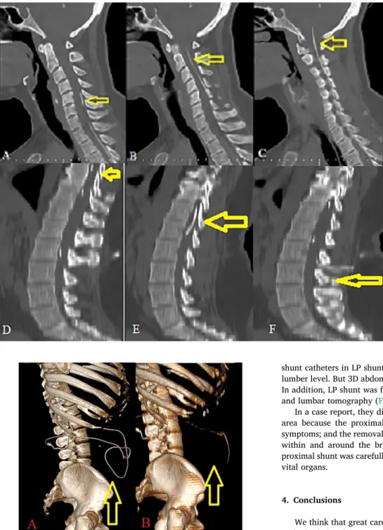 Fig. 3. (A) The yellow arrow indicates mi- mi-gration of the tip of shunt at the cervical level in sagittal section of toracolumbar CT.