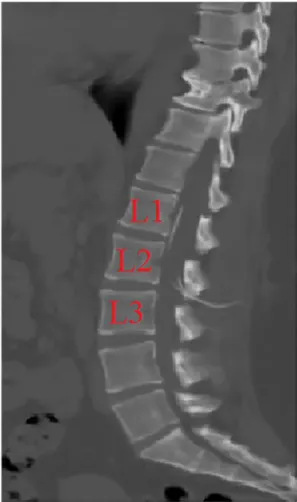 Fig. 5. Sagittal section of toracolumbar CT of ventriculoperitoneal shunt after the second operation.