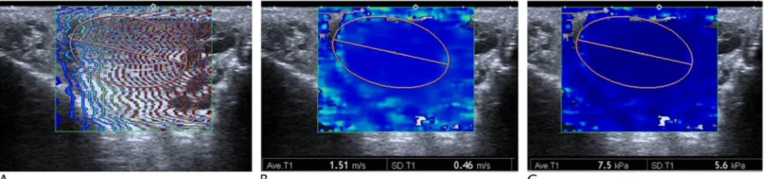 FIGURE 2. Varicocele on the left testis of a 38-year-old patient. Shear wave elastography images can be viewed using 3 display modes after freezing: propagation mode (A), speed mode (m/s) (B), and elasticity mode (kPa) (C)
