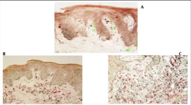 Fig. 3. A: A section from healthy gingiva. Epithelium (1), lamina propria (2). ANAE positive cells (3,4,5) are mainly located in the connective tissue