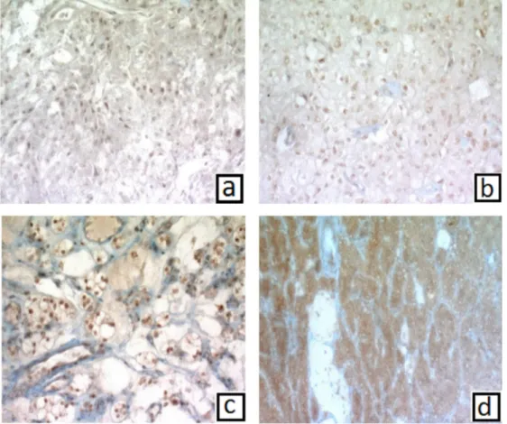 Fig. 1. According to immunohistochemical RBX-1 expression (a) clear RCC (+) RBX-1 expression ( £200), (b) chromophobe RCC (++) RBX-1 expression ( £200),(c) clear RCC (+++) RBX-1 expression (£200)(d) papillary RCC (+++) RBX-1 expression (£200)