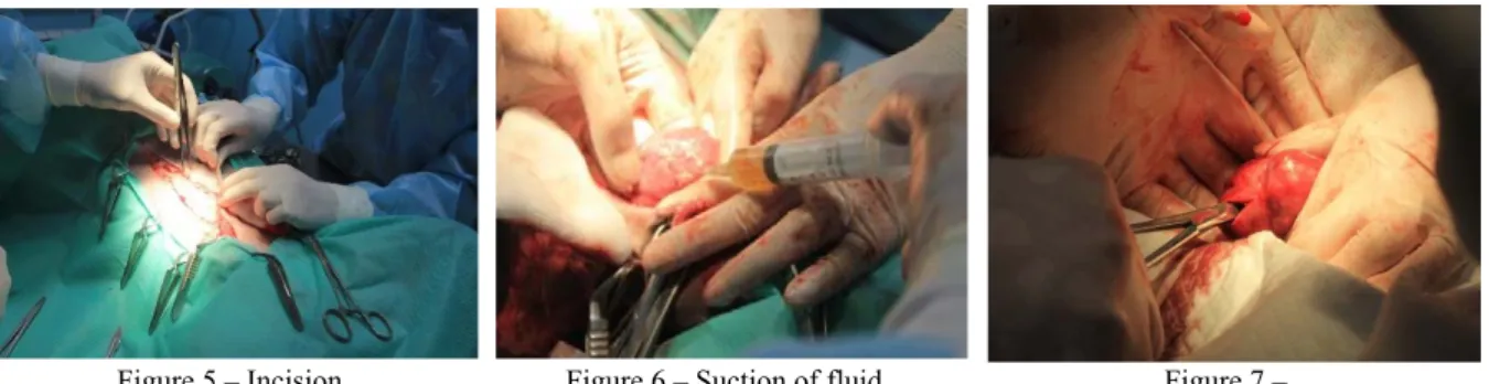 Figure 6 – Suction of fluid   from the tissues around the kidney 