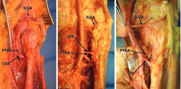 Fig. 3. Origin, course, and branches of the circumflex fibular artery and posterior tibial recurrent artery in three right specimens  showing variability in the origin of the circumflex fibular artery being from the anterior tibial artery (left), popliteal