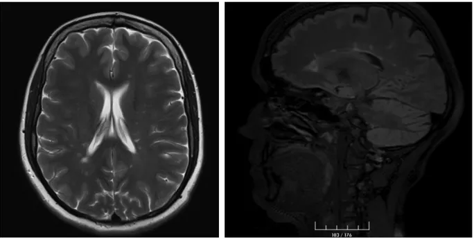 Figure 1. Large number of plaque-like lesions perpendicular to the ventricular system in the periventricular white matter of both cerebral hemispheres