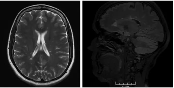 Figure 1. Large number of plaque-like lesions perpendicular to the ventricular system in the periventricular white matter of both cerebral hemispheres