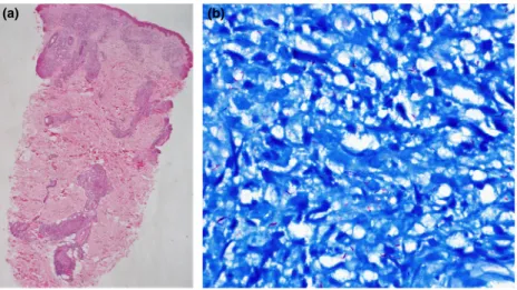 Figure 2 (a) Thinned out and flattened epidermis with preserved grenz zone. The dermis showed perivascular and periadnexal lymphohistiocytic collection with vague granuloma formation, while perineural involvement was noted in deeper dermis (H&amp;E, 940)