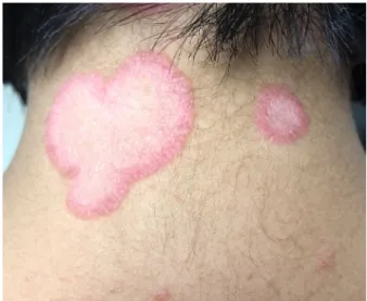 Figure 2 Right lower back. Thick pink arcuate plaques with erythematous borders and thick white scale