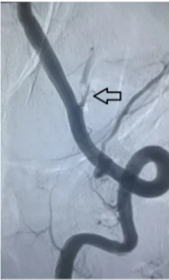 Fig. 1    Digital subtraction angiography (DSA) revealed the left PICA  occlusion (arrow)