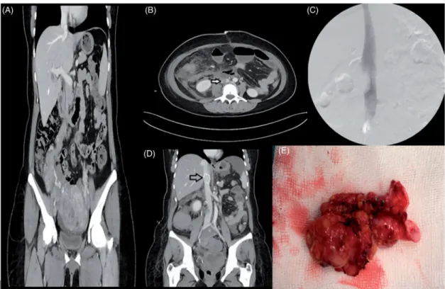 Figure 1. (A) The pre-operative CT view of the IVL which begins from the uterus and lying throughout right infundibulopelvic ligament, up to the entry of right renal vein in VCI